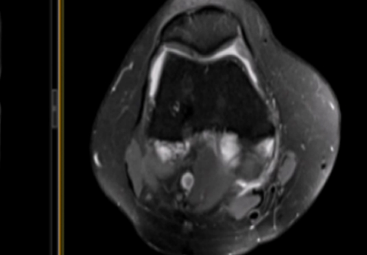 微創射頻消融術